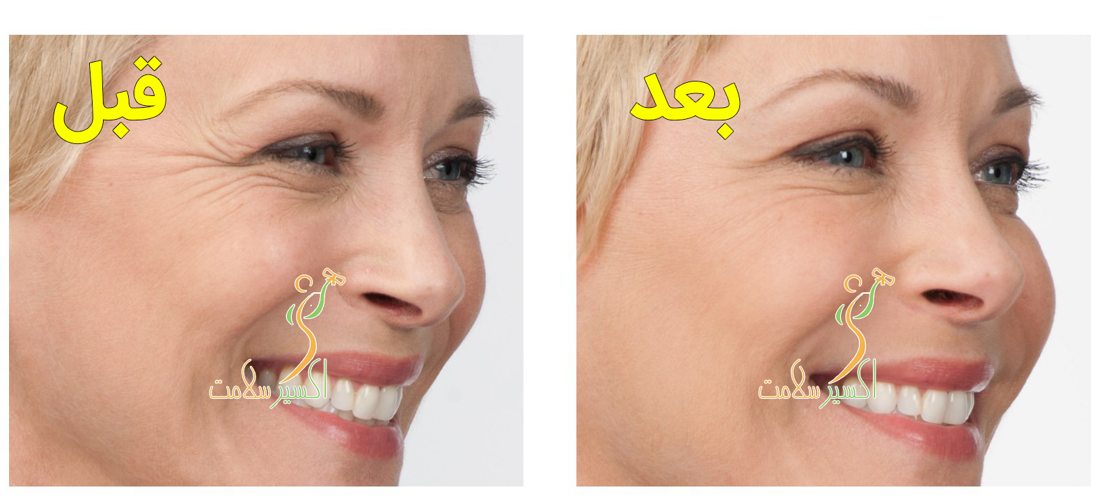تاثیر بوتاکس در رفع چین و چروک های اطراف چشم