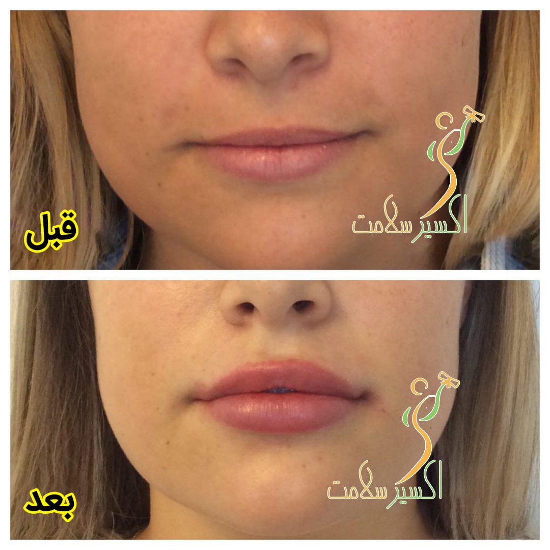 بوتاکس برای درمان چروک های دور لب
