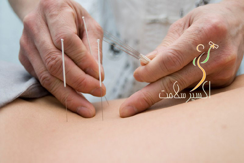 طب سوزنی