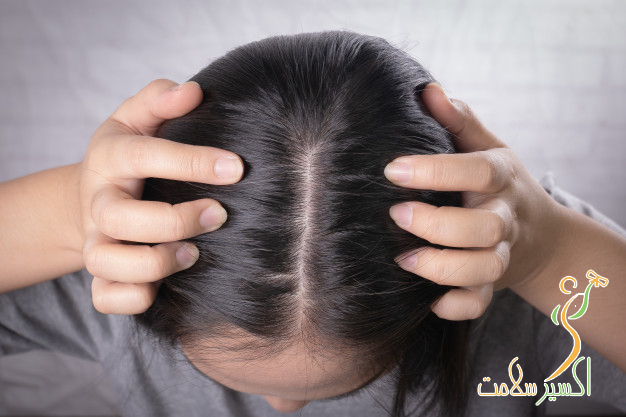 درمان  شوره سر 