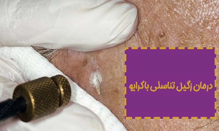 کرایوسرجری یا فریز کردن زگیل تناسلی چیست؟