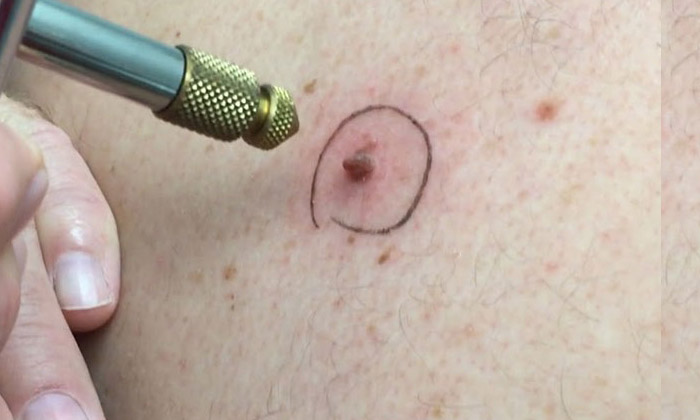 کرایوتراپی چیست و چرا انجام می شود؟