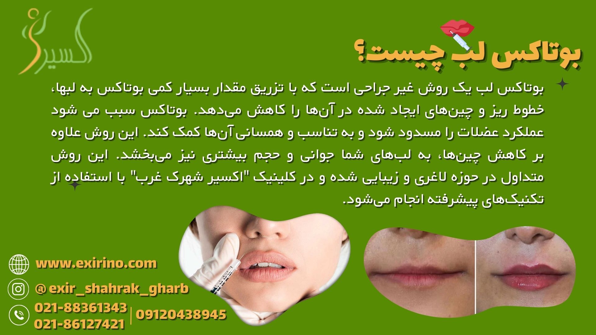 بوتاکس لب چیست؟