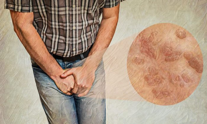 پیشگیری از ابتلا به زگیل تناسلی