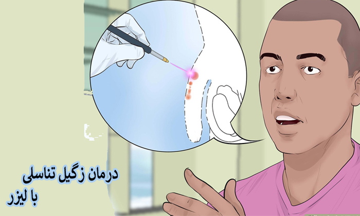 لیزر درمانی یا سوزاندن زگیل تناسلی در درمان HPV چگونه است؟