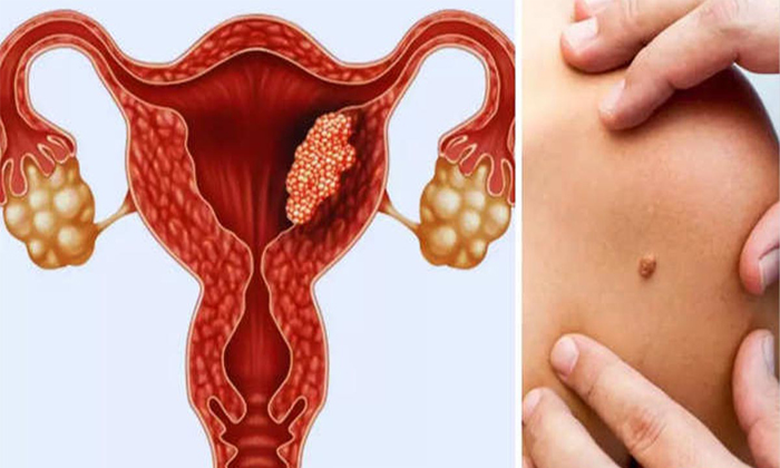 پیشگیری از ابتلا به زگیل تناسلی
