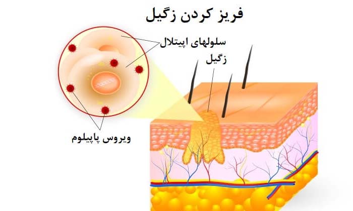 کرایوسرجری یا فریز کردن زگیل تناسلی چیست؟